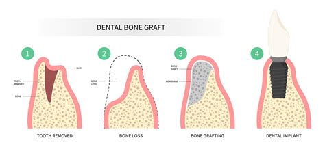 bone graft near me.